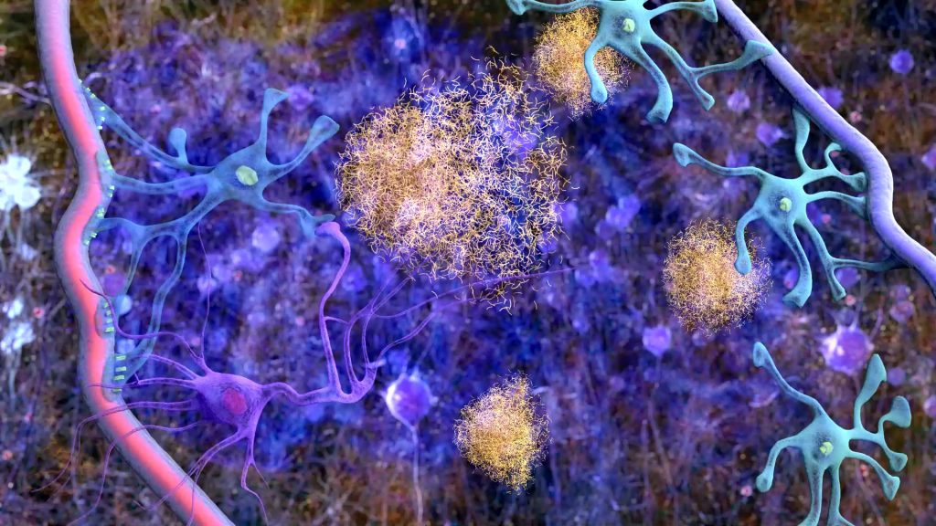 A cartoon shows a zoomed in section of brain tissue in which cerebrospinal fluid is washing over cells and big yellow amyloid plaques.